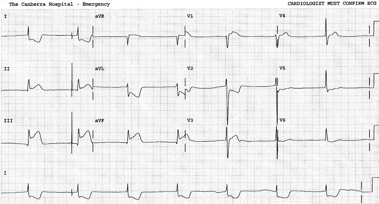 51 year old man with chest pain and shock. What are possible causes or contributors of shock in this setting?