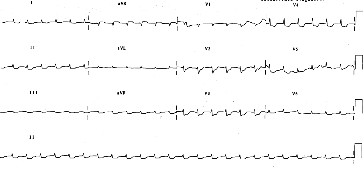 19 year old in septic shock from ruptured jejunum in a car accident; she had dense ARDS and severe hypoxÃ¦mia.