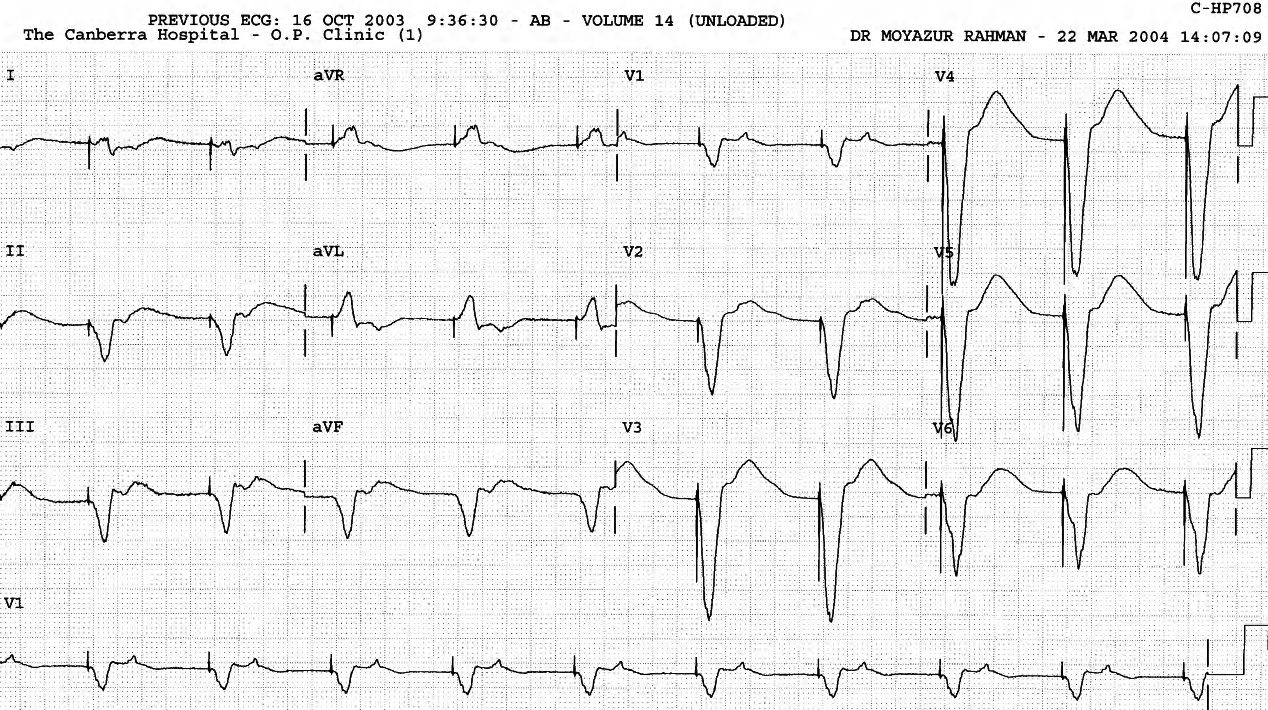 Pacemaker rhythm with retrograde VA block.  