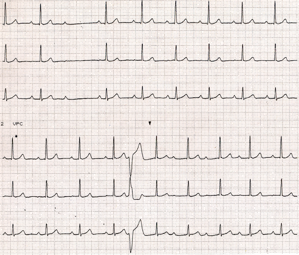 Atrial flutter with 4:1 block. Prominent U wave is seen in V4, for any of the (un)known reasons. 