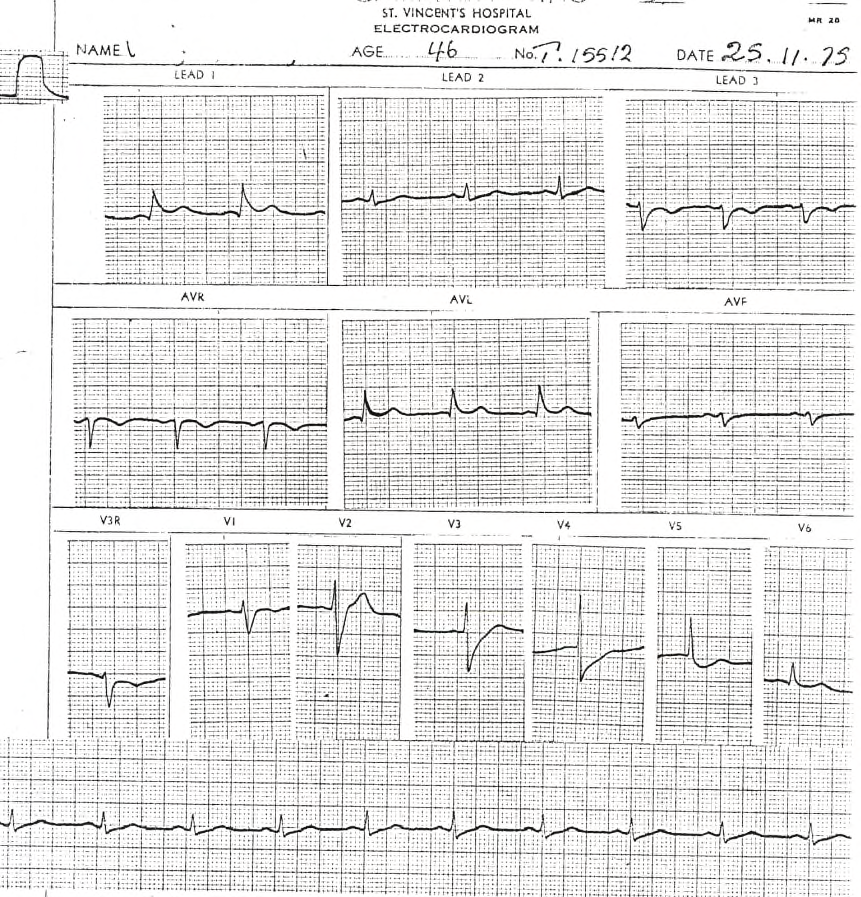 46 year old lady rushed from the Clinic to CCU because of this ECG. I would have sent her home, but was overruled, being only a Registrar.