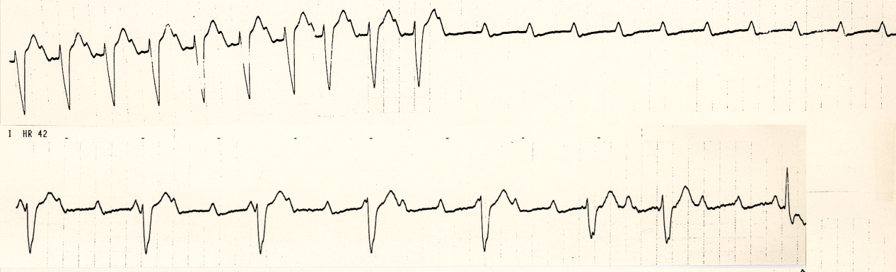 81 year old woman with ischÃ¦mic cardiomyopathy accidentally     disconnected from the temporary pacemaker in CCU. List 4     electrocardiographic diagnoses. 