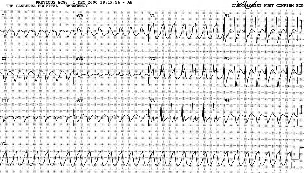 72 year old man with history of mitral valve replacement and chronic AF. Adenosine and Valsalva manoeuvre by the paramedics were unsuccessful; xylocaine restored AF. 