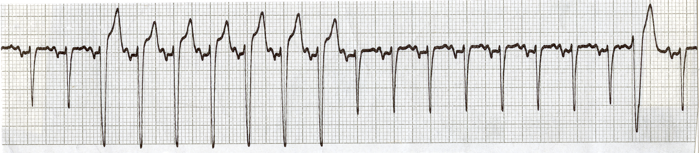 Seven large complexes synchronous with sinus tachycardia: a form of double tachycardia, consisting of identical fusion beats! The penultimate beat is a âpureâ VEB. 