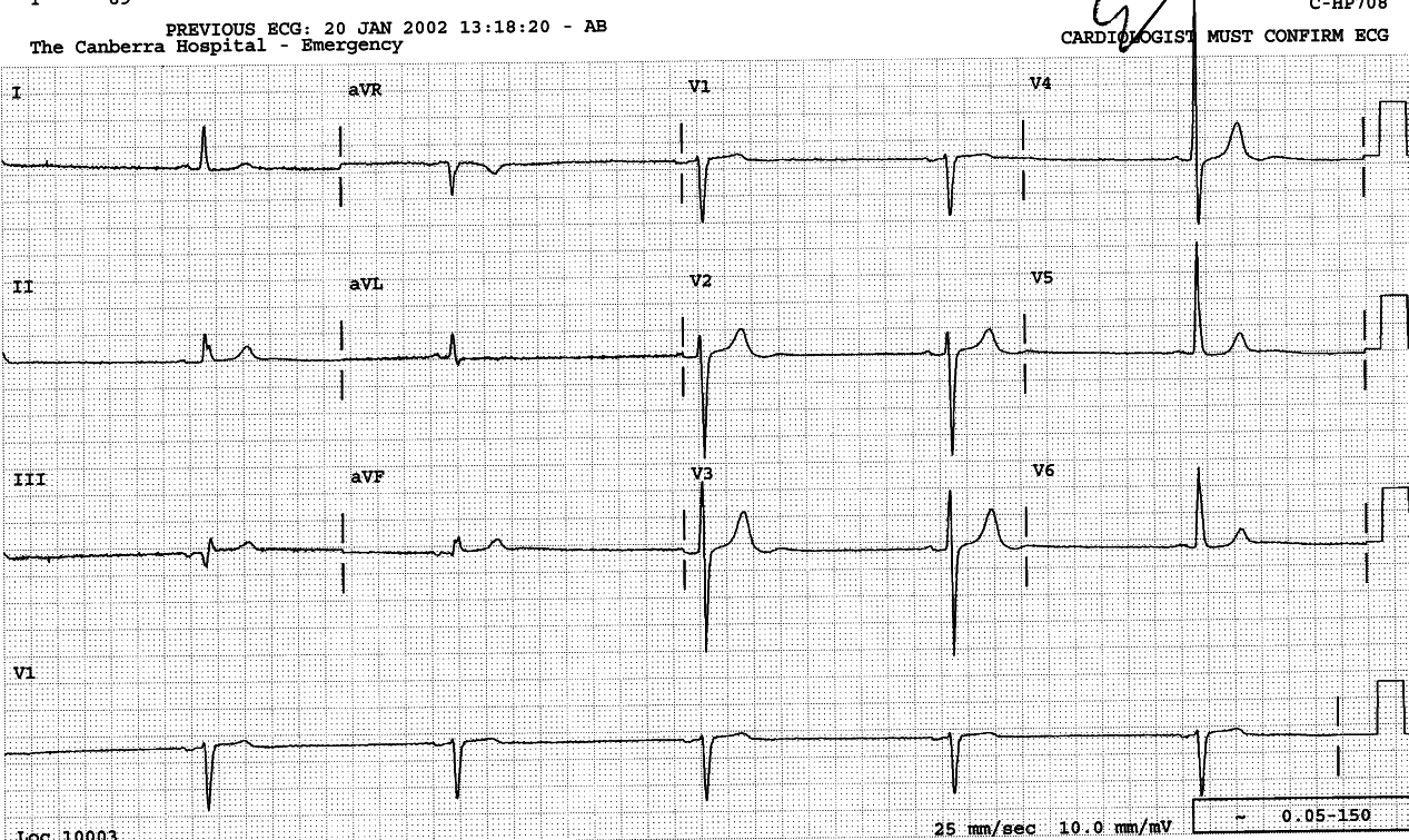 Blocked P waves âskippedâ during 3:2 Wenckebach conduction with unusually long PR intervals.