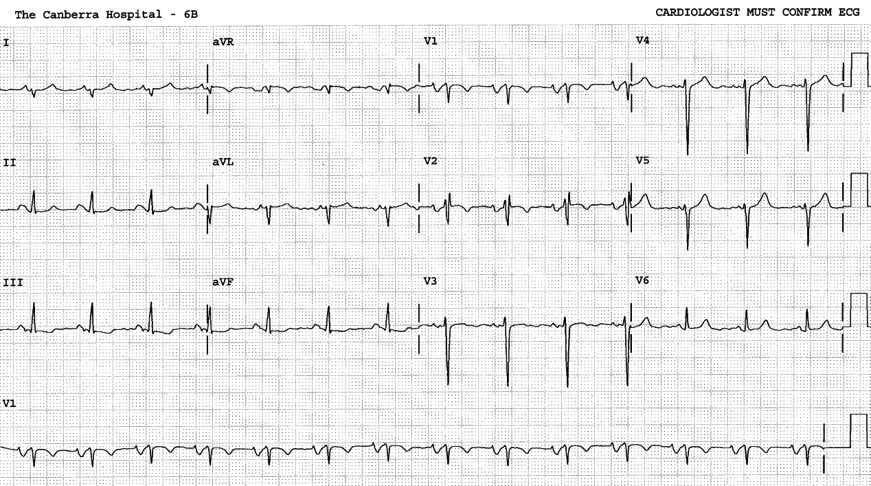 26 year old lady with Carneyâs syndrome