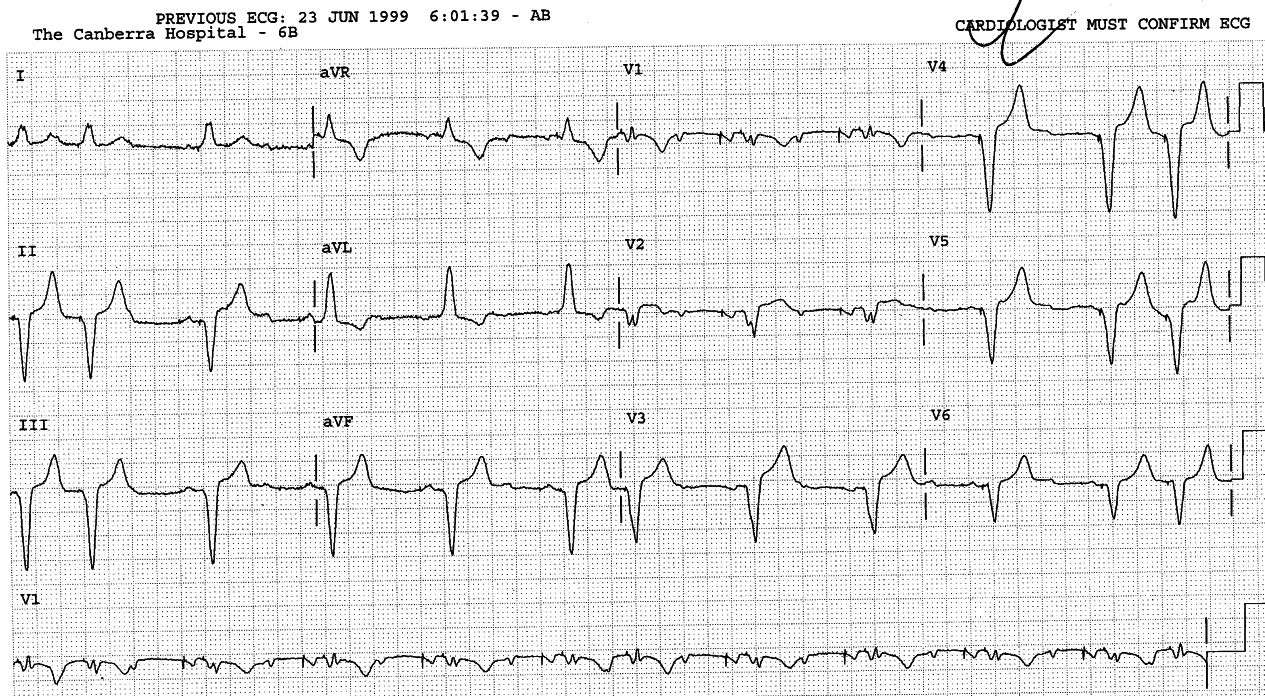 69 year old lady two days following
CABGs.