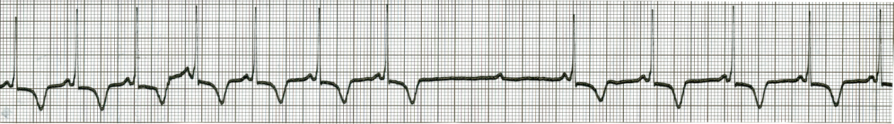 42 year old Negress with no cardiac history or findings. The     tracing (lead 2) was taken during carotid sinus massage in the course of     a routine postoperative examination for an unrelated condition. Why was     the carotid massage performed? 