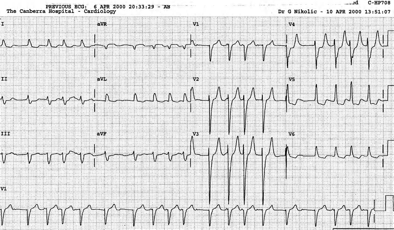 Over the top conduction of PAT with block. The QRS is seen devoid of the broad primary R wave seen in the original tracing. 