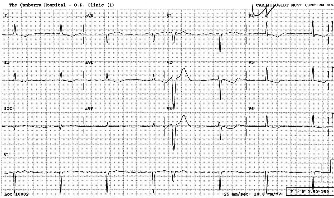 Onset of 2:1 block (top) followed by 1:1 conduction at a slower sinus rate, presumably reflecting hÃ¦modynamic improvement. 