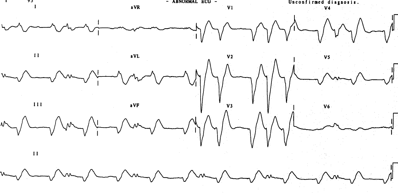 Trigeminy with interpolated VEBs probably induced by the pacemaker.