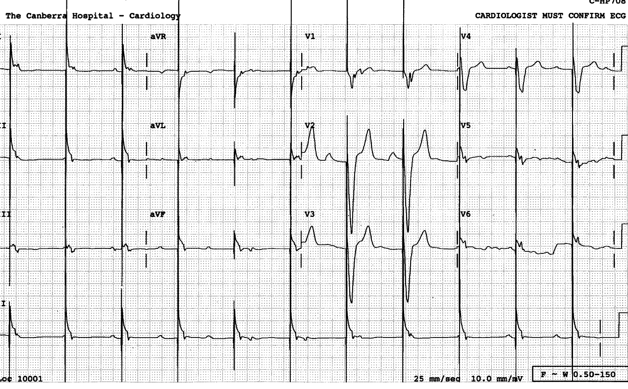 66 year old lady with a permanent
pacemaker. Its electrode is unipolar.