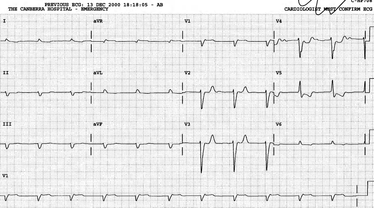 Junctional rhythm with retrograde P wave only seen as secondary R wave in V1. The U wave in V4 mimes sinus P wave. 