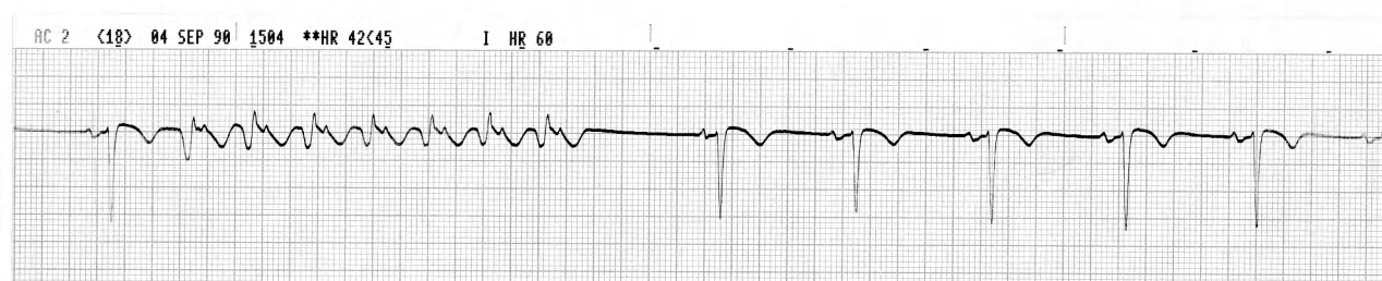 Seven small complexes causing alarming but spurious bradycardia in a 58 year old man with unstable angina. He had multi-organ failure following peripheral vascular surgery but made it to CCU, now on metoprolol. 