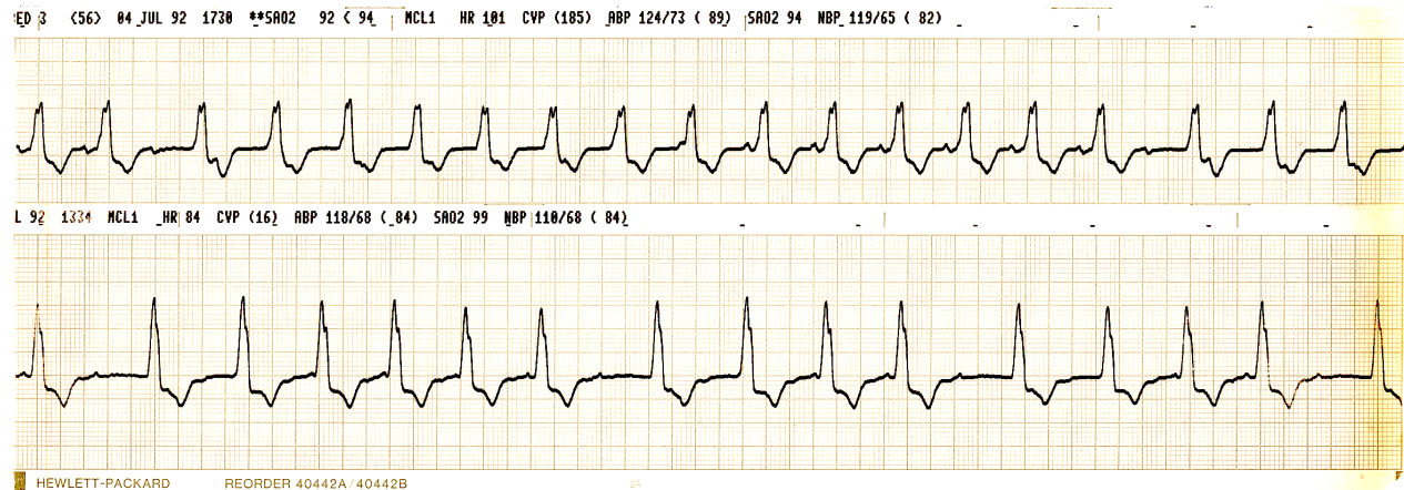 61 year old man with history of remote myocardial infarction, on metoprolol 200 mg daily. 