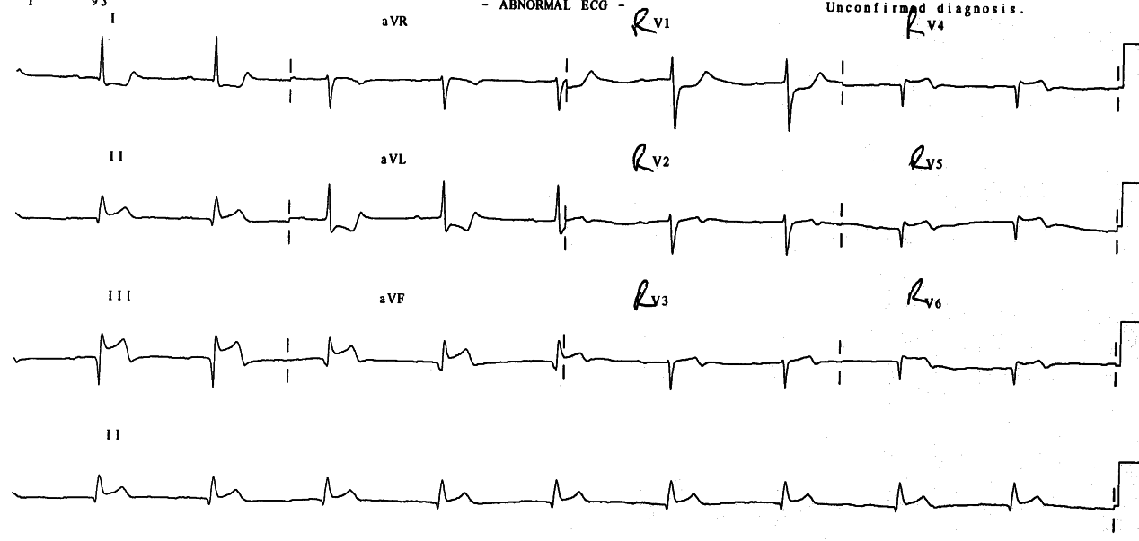 Right-sided leads documenting RV infarction. There probably is a 2:1 AVB.