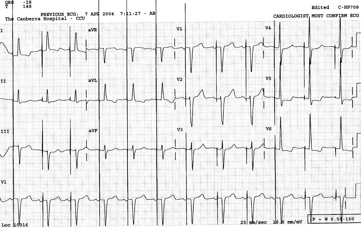 75 year old man with hypertrophic cardiomyopathy and history of
sudden unprovoked falls. A permanent pacemaker had been inserted day
before the recording below.