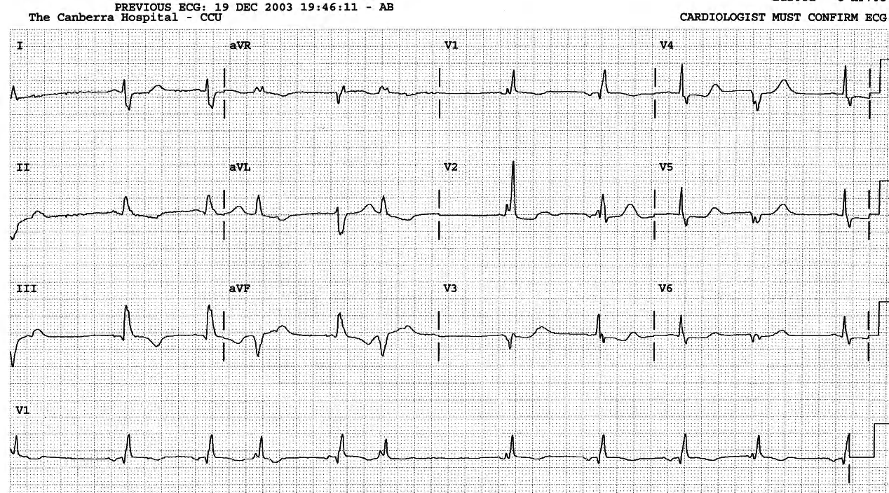 The basic parasystolic interval is between the second and the third VEB, also between the third and the fourth.. 