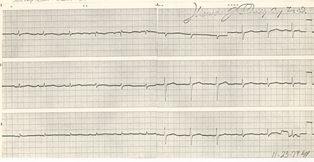 73 year old lady with high creatine phosphokinase (CPK) levels