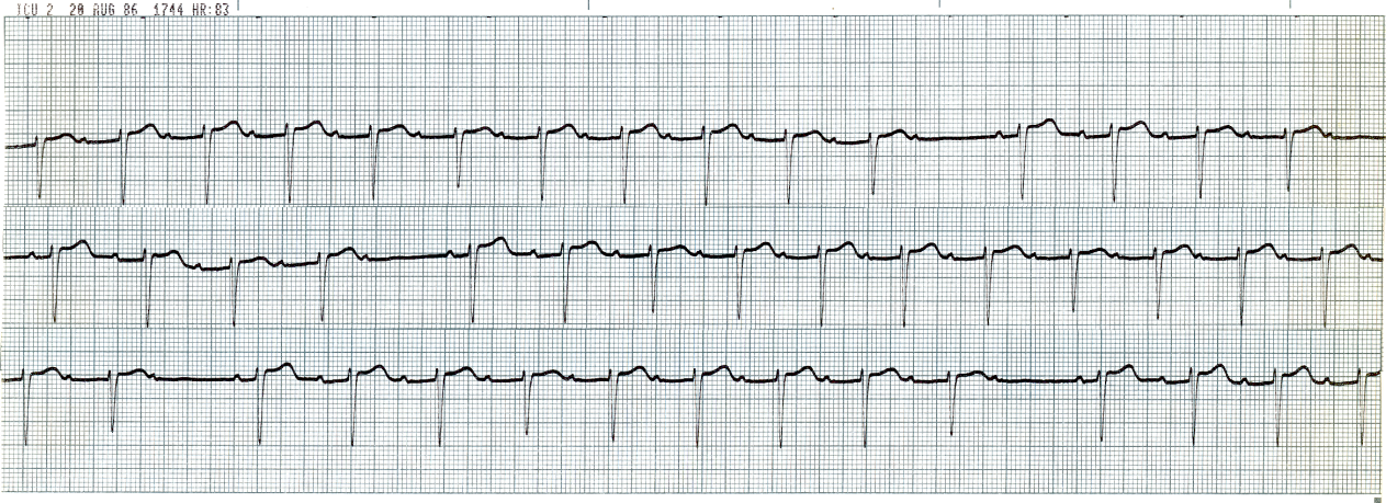 48 year old man on verapamil therapy for     hypertension. The strip below was obtained 8 hours after an uneventful     carotid endarterectomy. 