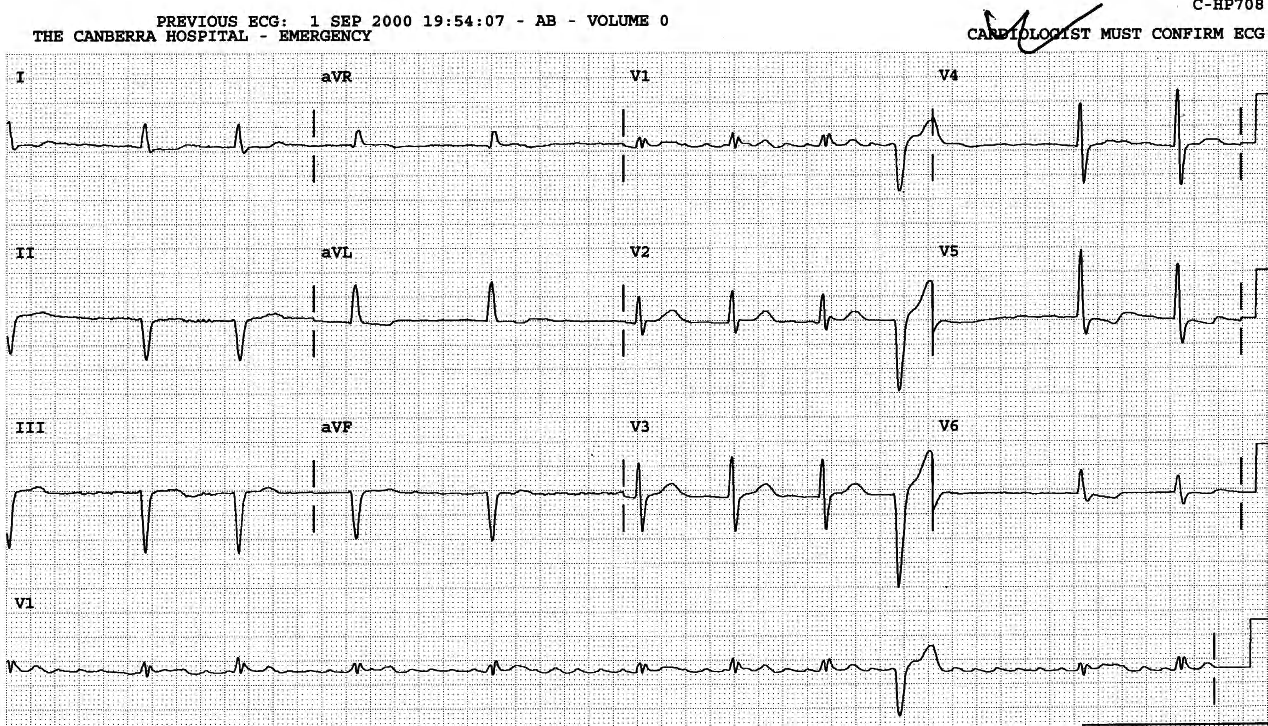 Even in AF, VEBs have a tendency to induce a pause, although its âcompensatoryâ features cannot be measured. Aberrant beats donât. [! XE "VEBs:\"compensatory\" pause in AF" !]