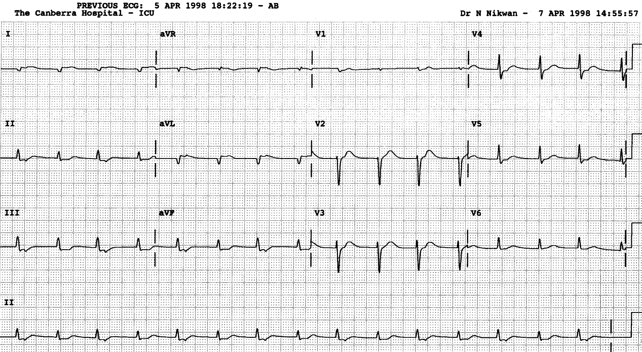 53 year old man on Day 3 of a large inferoposterolateral infarction. What makes the left anterior descending artery disease a likely part of his predicament? 