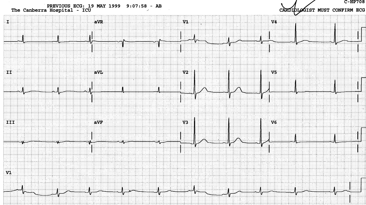 Ventilated 43 year old man with massive intracranial hÃ¦morrhage from a known AV malformation.