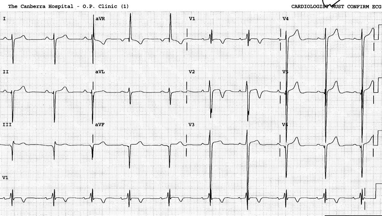 29 year old man with heart murmur for many years and recent episode of pulmonary Ådema