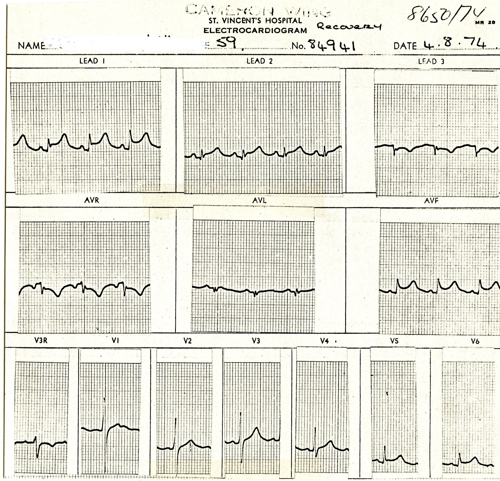 59 year old man following left upper lobectomy.