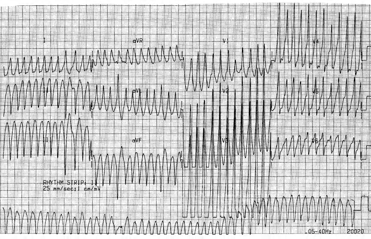 Well tolerated tachycardia in a 15 year old boy. 