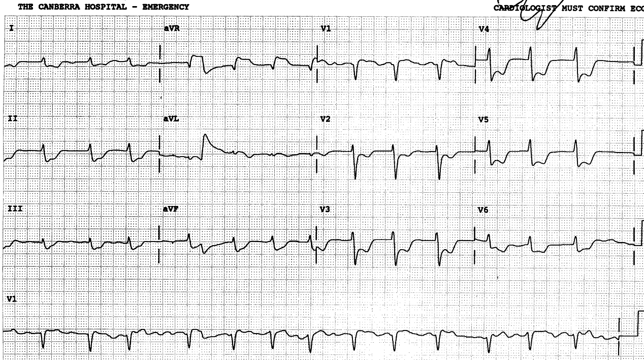 58 year old man resuscitated from out-of-hospital VF cardiac arrest, only to die again in Casualty.