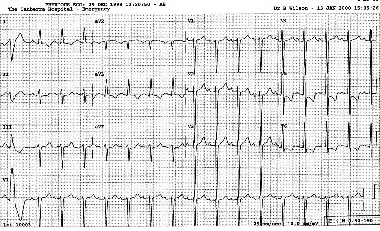 Sinus rhythm, VEB, LVH with ST/T changes. 