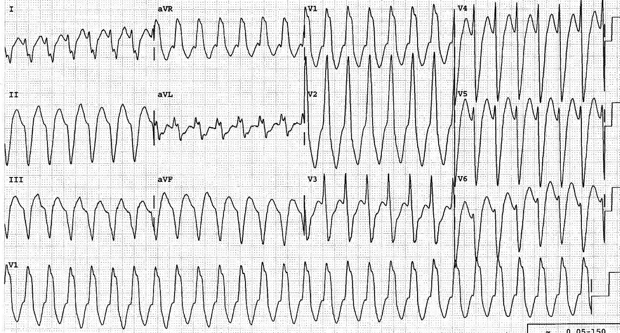 78 year old man with permanent pacemaker. 