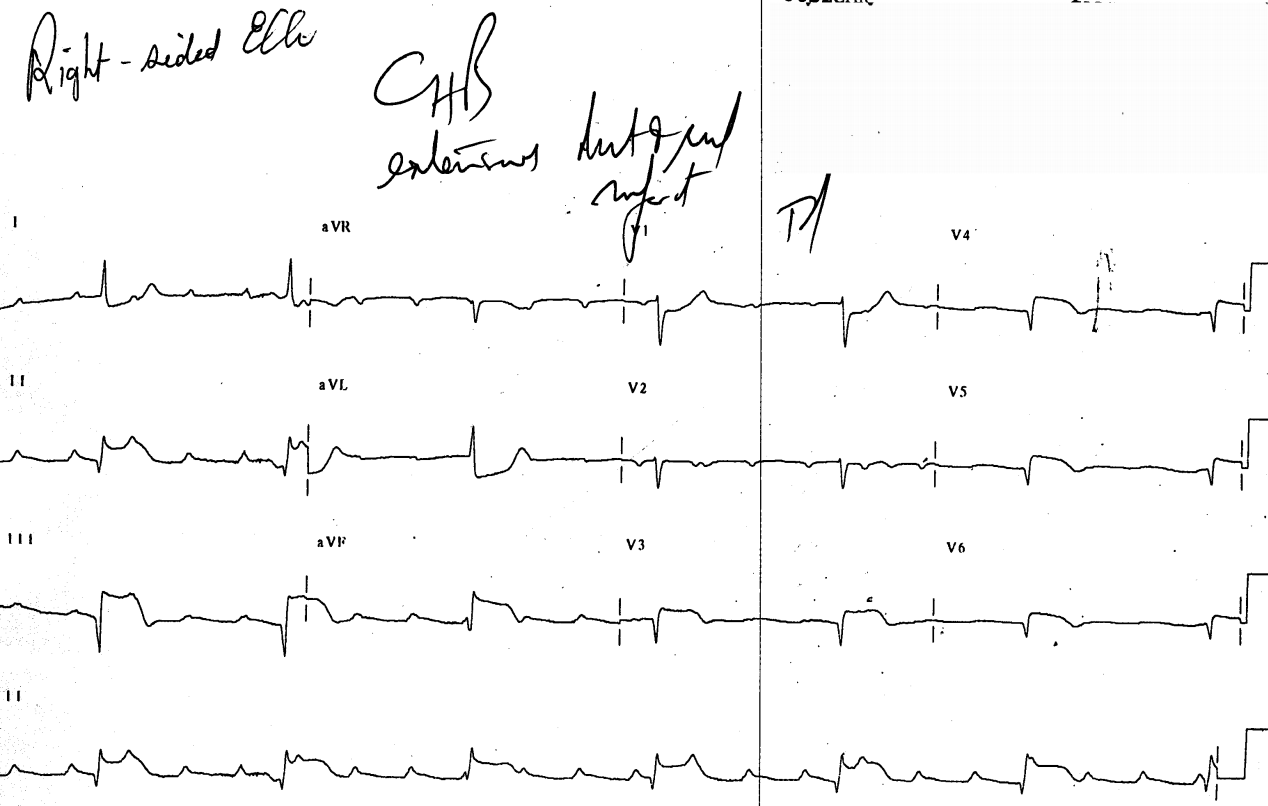 50 year old man with chest pain and bradycardia. The chest leads are right-sided, but were not labeled as such.