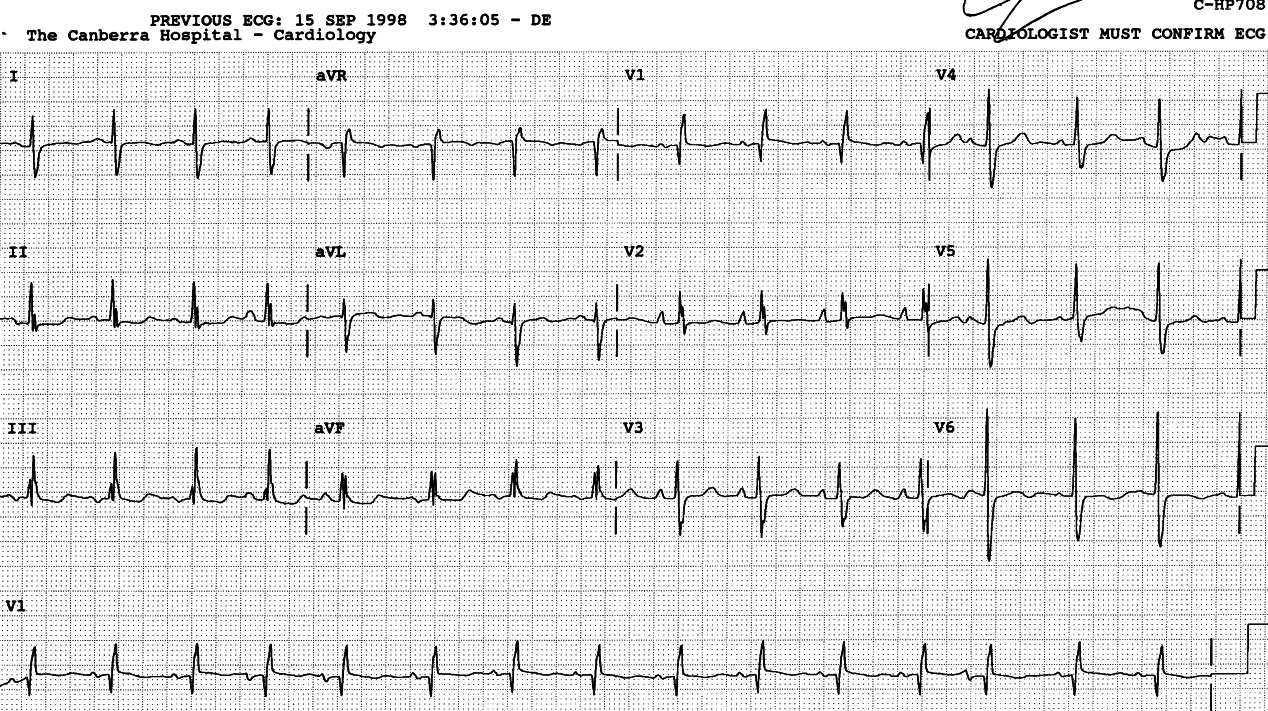 67 year old lady with single-vessel coronary disease, discovered to have a shunt during bypass surgery