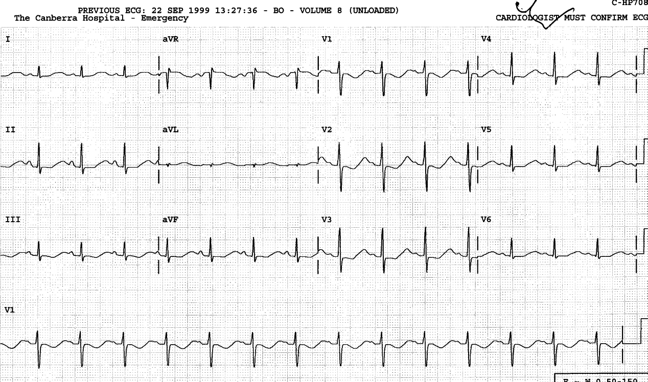 32 year old lady, alkalotic from prolonged vomiting