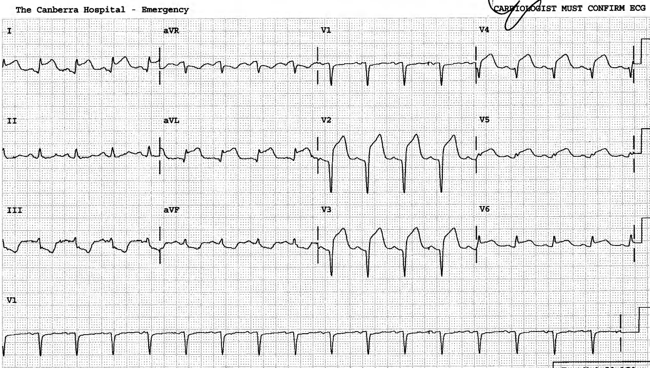 Admission ECG, showing acute or recent extensive anterior infarction. 