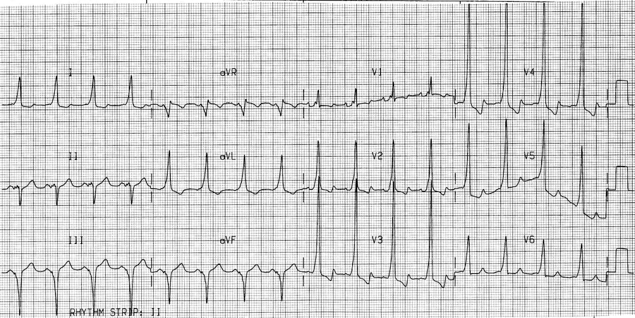 Sinus rhythm confirms the obvious. A regular antidromic SVT or flutter would be indistinguishable from VT. 