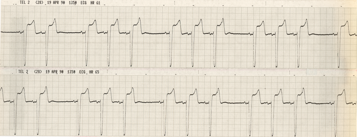 Routine monitoring on a 73 year old man with angina, controlled by Î²-blockers. 