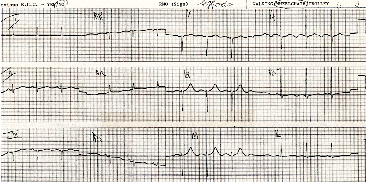 Routine ECG on a 74 year old lady with jaundice for investigation. She was found dead in bed the following day.