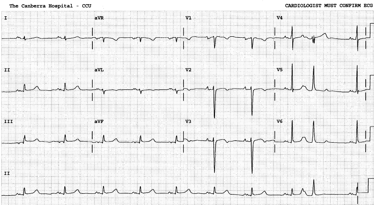 35 year old immigrant with history of rheumatic fever