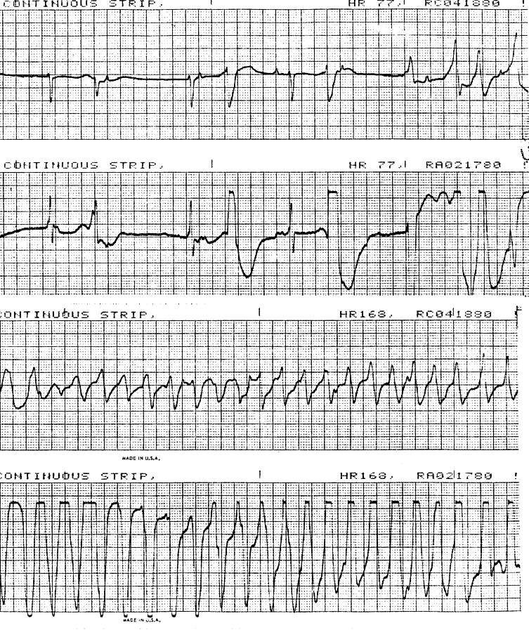 Holter strips on a 64 year old lady with history of three MIs, studied for asymptomatic bradycardia. She died during the study