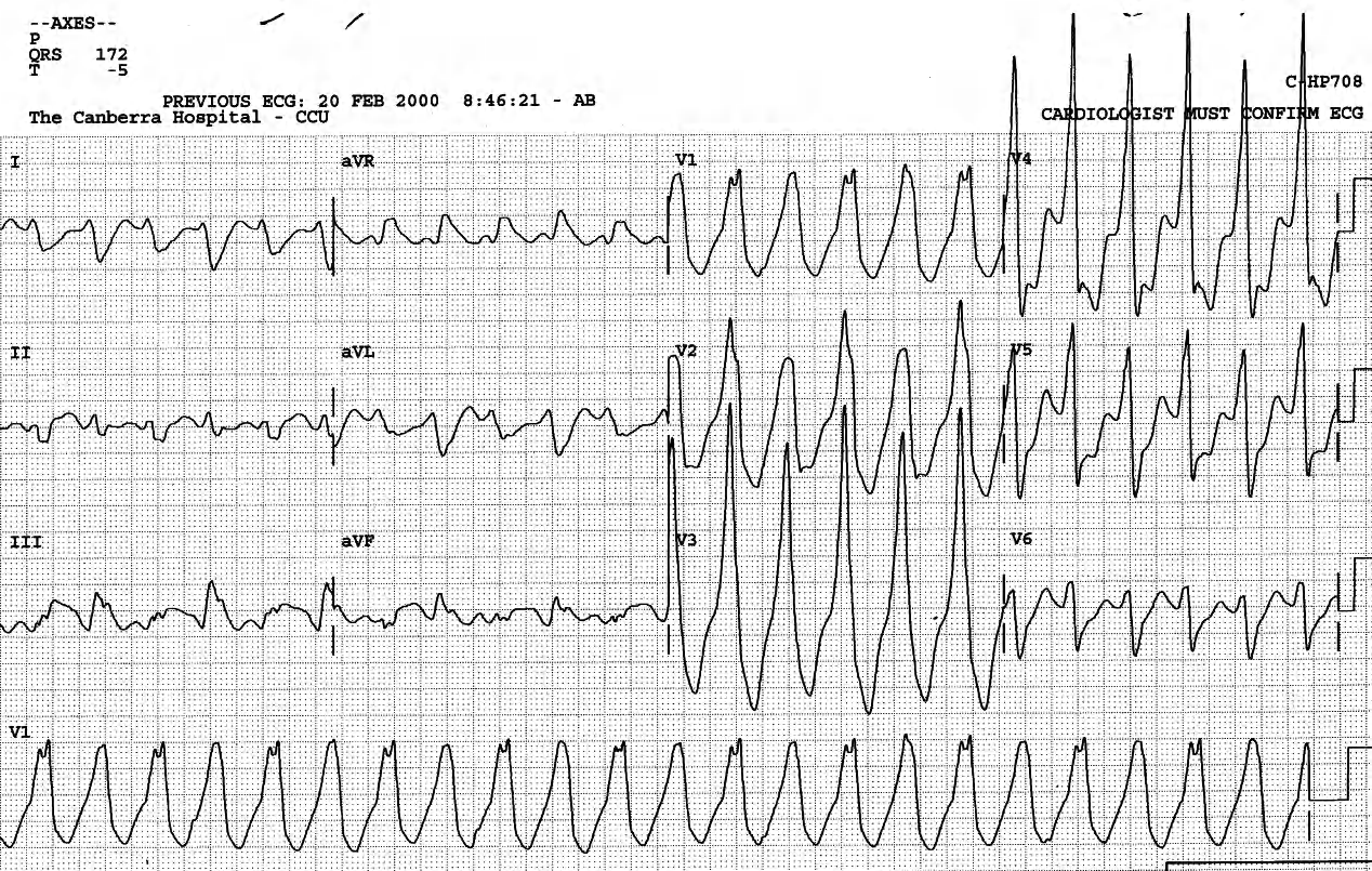 45 year old man in end-stage renal failure, on sotalol for recurrent tachyarrhythmias. 