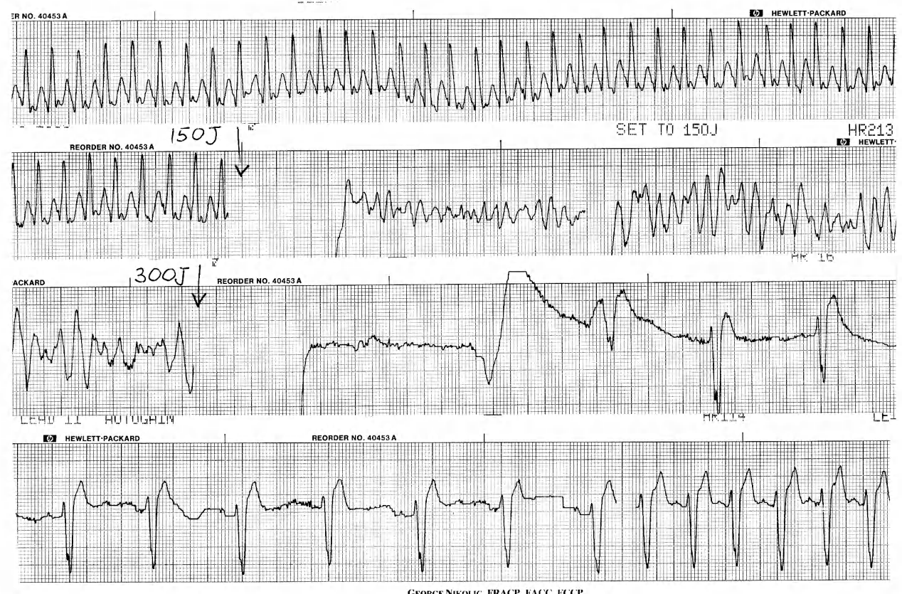 73 man with 4 hours' dyspnoea & palpitations; there was no response to Xylocaine, which cost him. 