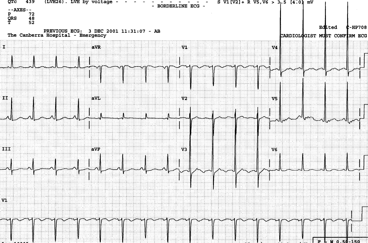 78 year old lady with chronic hypertension and COAD, but no cardiac history.