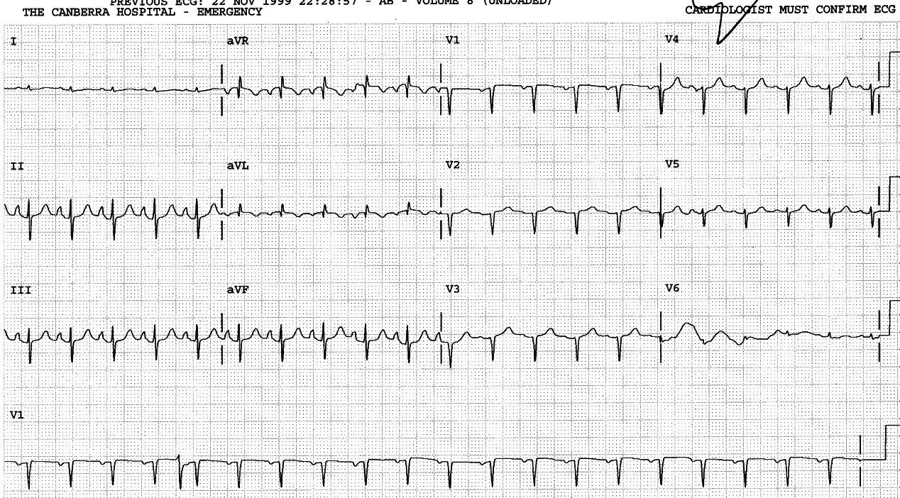 70 year old lady with emphysema