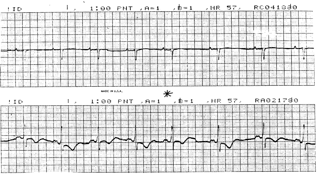 T wave alternans.