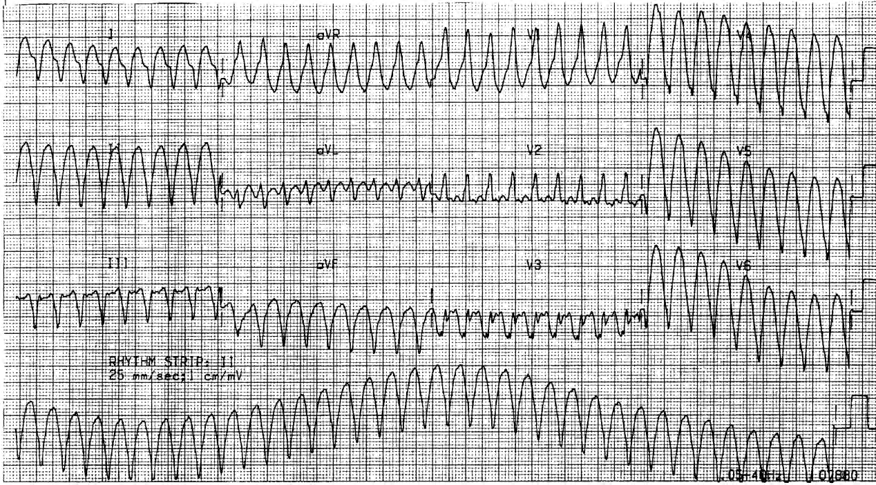 VT in 12-lead ECG. 