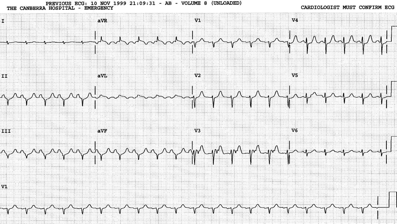 There is a mechanical RV impulse distorting V3.