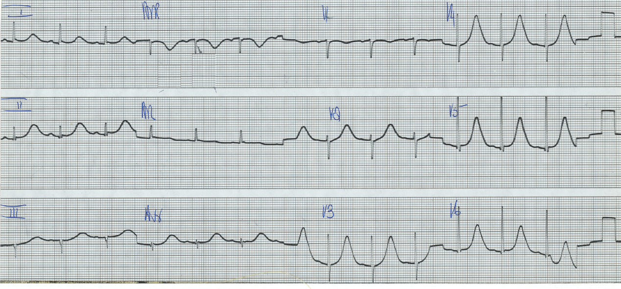 56 year old alcoholic on alphamethyldopa, chlorothiazide and (too little or too much?) potassium supplements